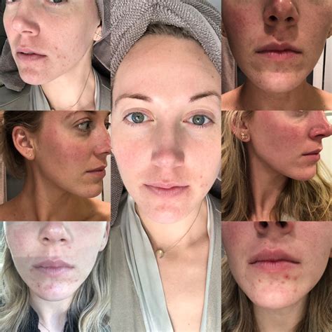 “Decoding Breakouts After HydraFacial: What’s Normal.